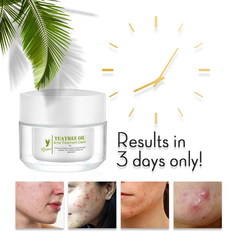 KStims Natural Acne Treatment  - Tea Tree Spot Treatment review and price