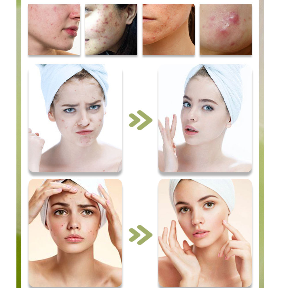 KStims Natural Acne Treatment  - Tea Tree Spot Treatment review and price